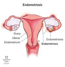 Endometriosis